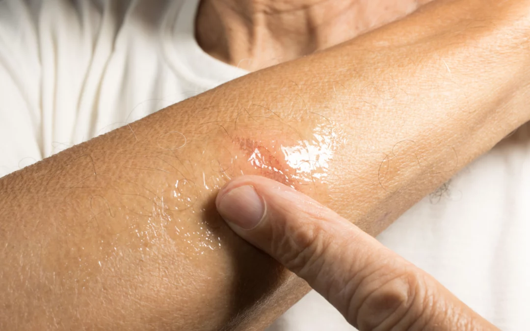 Utiliser l’aloe vera pour traiter les brûlures mineures et les coupures