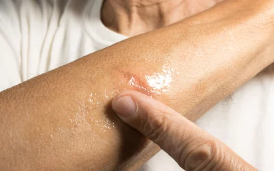 Utiliser l’aloe vera pour traiter les brûlures mineures et les coupures